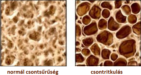 csontritkulás fájdalomcsillapító