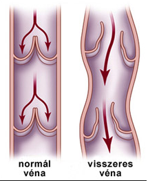 lehet valami rendben a visszérrel